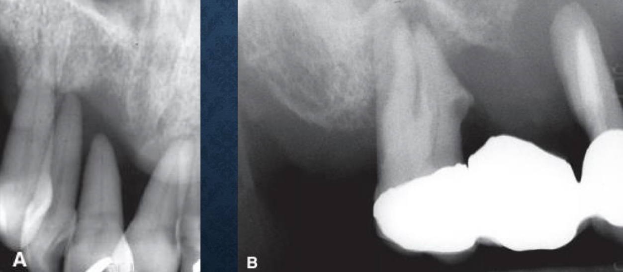 <p>if you see tooth floating in the air on a radiograph, it is likely…</p>