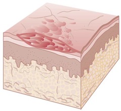 <p>Secondary lesion; thin, flaking layers of epidermis.</p><p>Psoriasis is an example of scales.</p>