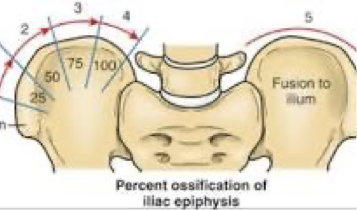 <p>risser’s sign </p>