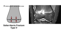 <p>define a salter harris type V fracture</p>