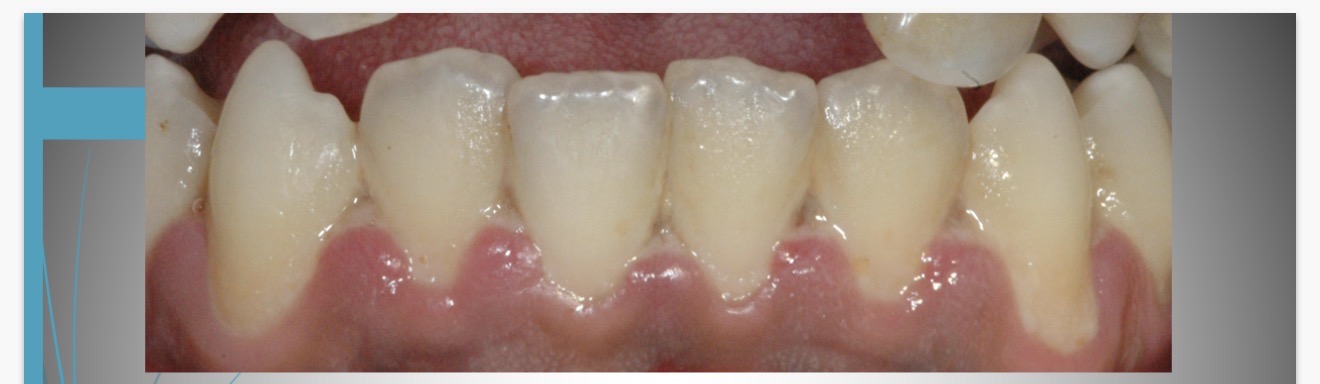 <p>This patient complains of an itching, wedging sensation, bad breath and pain when she brushes. She also says she feels "run down."</p><p>What is her condition?</p>