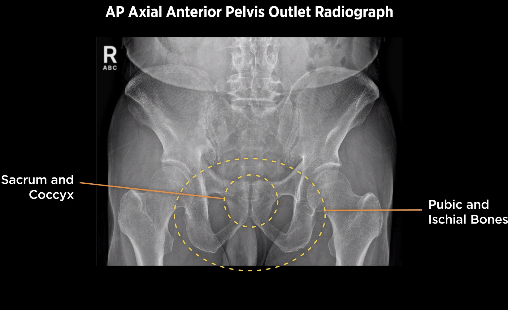 <p>30-45 degree cephalic angulation for women</p>