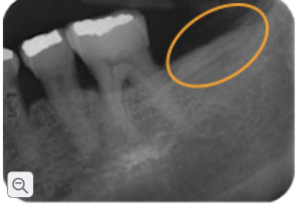 <p>external oblique ridge/ external oblique line</p>