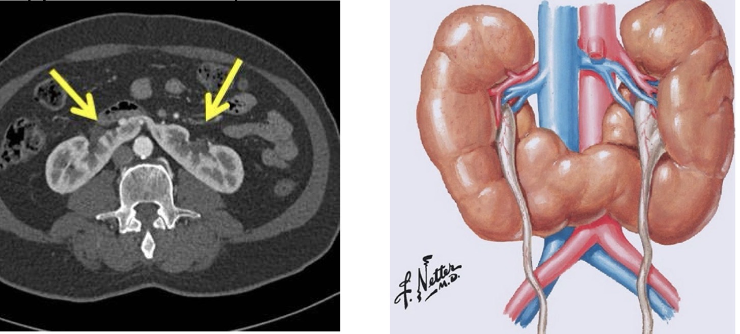 <p>Very large horseshoe shaped kidneys that make a person prone to kidney stones and UTI</p>