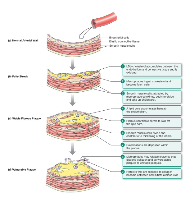 <p>As foam cells, and smooth muscle cells accumulate, a bulging plaque forms</p>