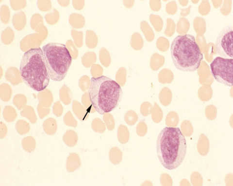 <p>seen in AML- auer rods, fine chromatin, prominent nucleoli</p>