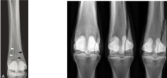 <p>What is this type 3rd metacarpal (cannon) bone fracture? Who commonly gets it?</p>