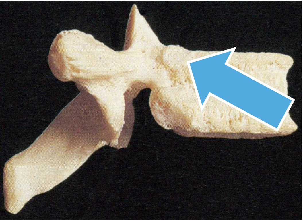 <p>Feature of Thoracic vertebrae. The result of articulation with the ribs </p>