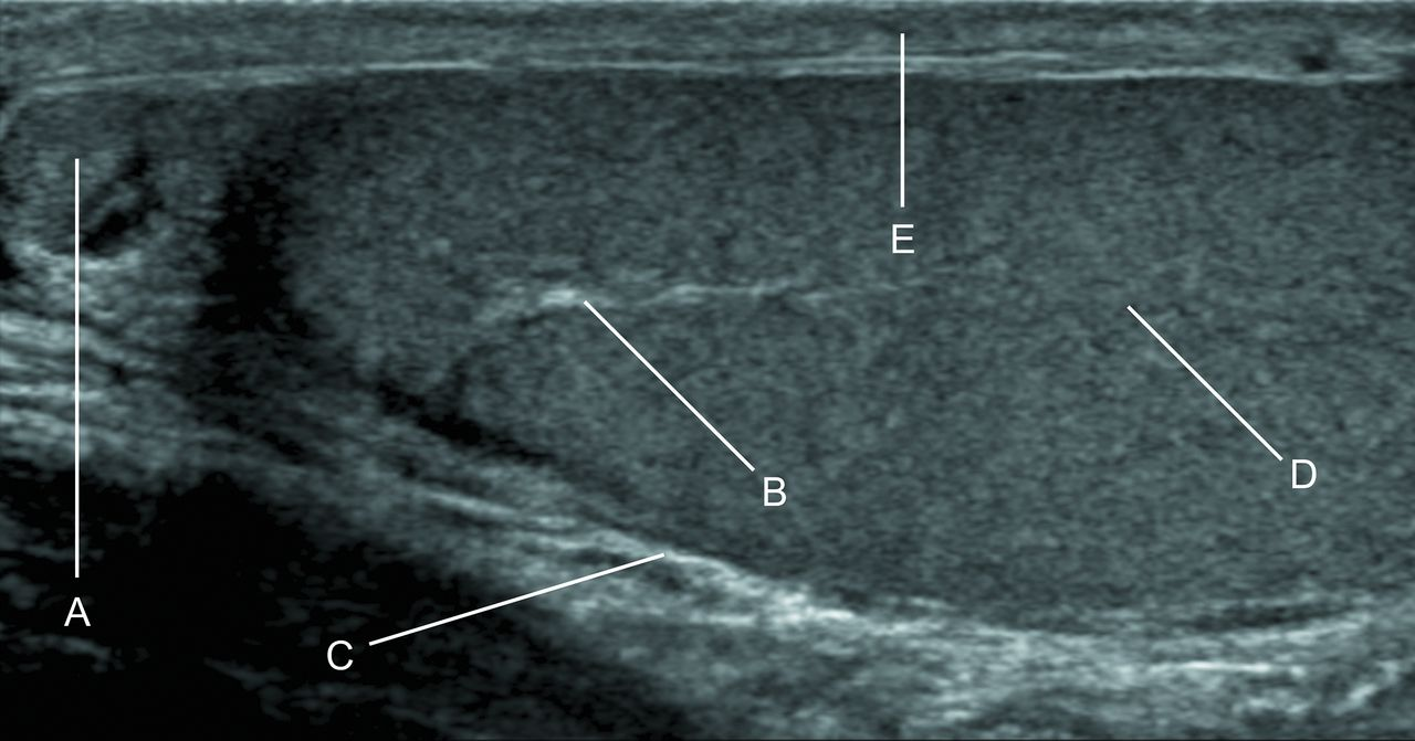 <p>What is labeled B?</p><p> </p><p>mediastinum testis.</p><p> </p><p>epididymal cyst</p><p> </p><p>epididymis</p><p> </p><p>testicular torsion</p>