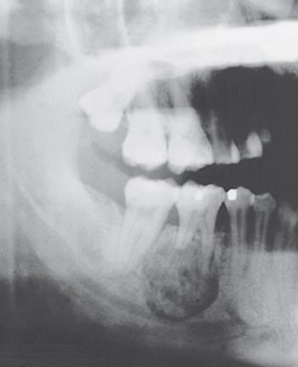 <p><br>-shows a well circumscribed radiopaque mass surrounded by a radiolucent halo and attached to the root of a mandibular first molar</p><p>-pain is a frequent symptom</p><p>-occurs in young adults and most occur in patients under 30</p>
