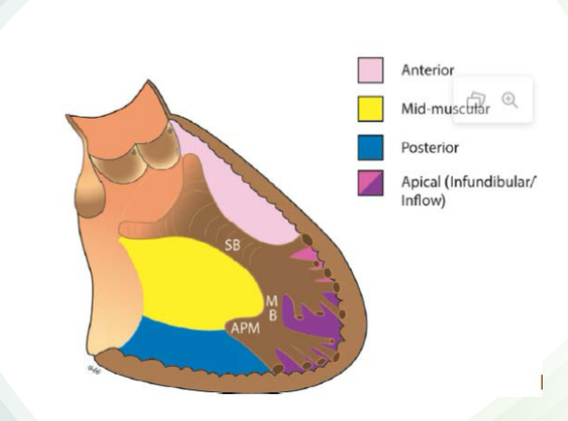 <ul><li><p>Anterior</p></li><li><p>Mid-muscular</p></li><li><p>Posterior</p></li><li><p>Apical</p></li></ul><p></p>