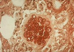 <p>Coccidioidomycosis (Valley Fever)</p>