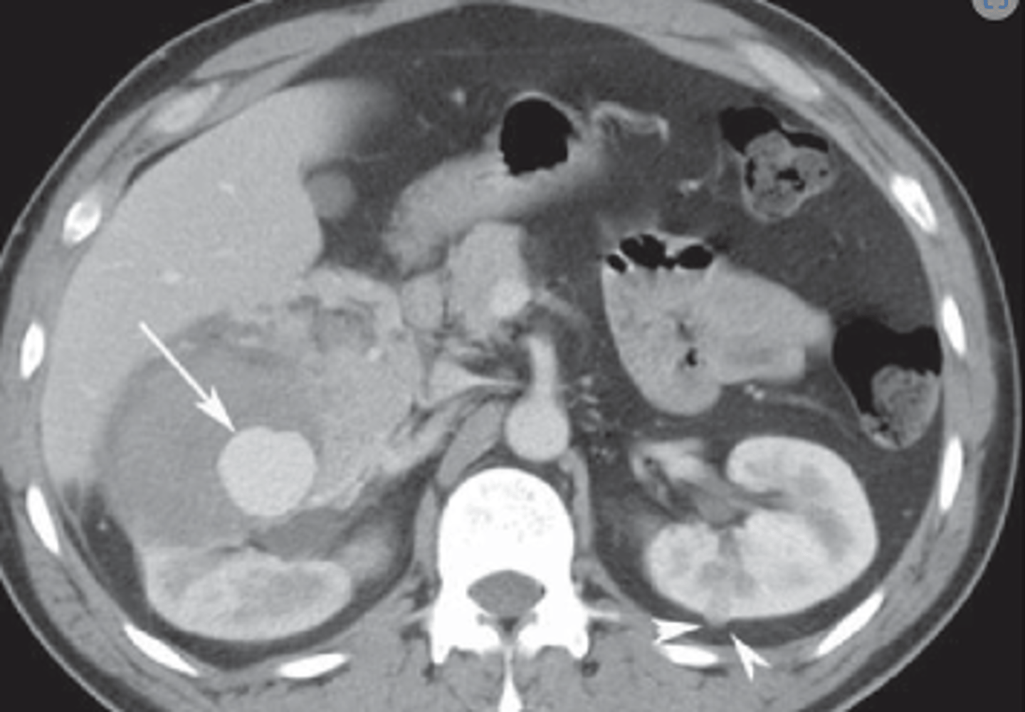 <p>Angiomyolipomas (fat containing lesions) are characteristic</p>