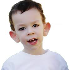 <p>Describe two dysmorphic features of the following patient with Fragile X syndrome.</p>
