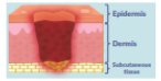<p>pressure injury: stage three</p>