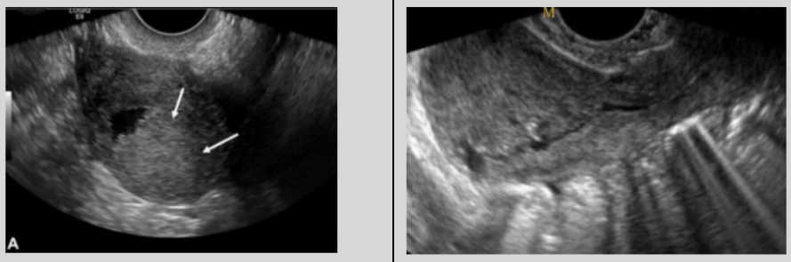 <ul><li><p><span style="background-color: transparent;">Arises from placental implantation site</span></p></li><li><p><span style="background-color: transparent;">Tumor can infiltrate myometrium and grown between smooth-muscle cells</span></p></li></ul><p></p>