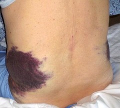 <p>-Massive ecchymosis noted on the flanks</p><p>-due to pancreatitis</p>