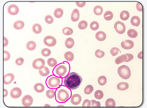 <p>microcytic, hypochromic</p>