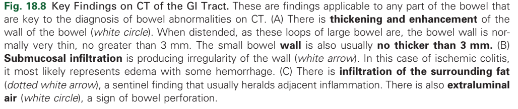 <p>thickening and enhancement of the bowel wall</p>