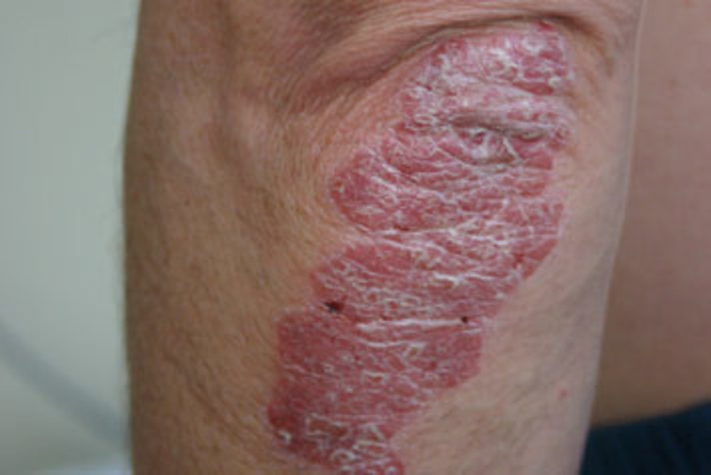 <p>genetics, obesity, injury induced (or vitiligo)</p><p>- eryhtematous, well demarcated, silvery scale</p>