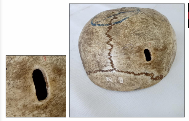 <p>Questions</p><ol><li><p>What is the specimen being examined?</p></li><li><p>What are the type, specific descriptive features, and dimensions of the fracture?</p></li><li><p>What type of causative instrument and cross-sectional shape produce this injury?</p></li><li><p>How is the time of death estimated?</p></li><li><p>What are the possible causes of death?</p></li><li><p>What is the final diagnosis for this specimen?</p></li></ol><div data-type="horizontalRule"><hr></div><p></p>