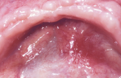 <p>Clinical term for a red patch not explained by another condition.</p>