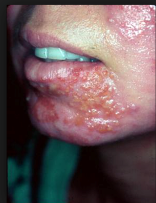 <p>Causative Agent: Staphylococcus aureus possessing exfoliative toxin A and B gene<br>Symptoms/Signs: Lesions around the mouth, face, and extremities; peeling skin, crusty and flaky scabs, or honey-colored crusts.</p>