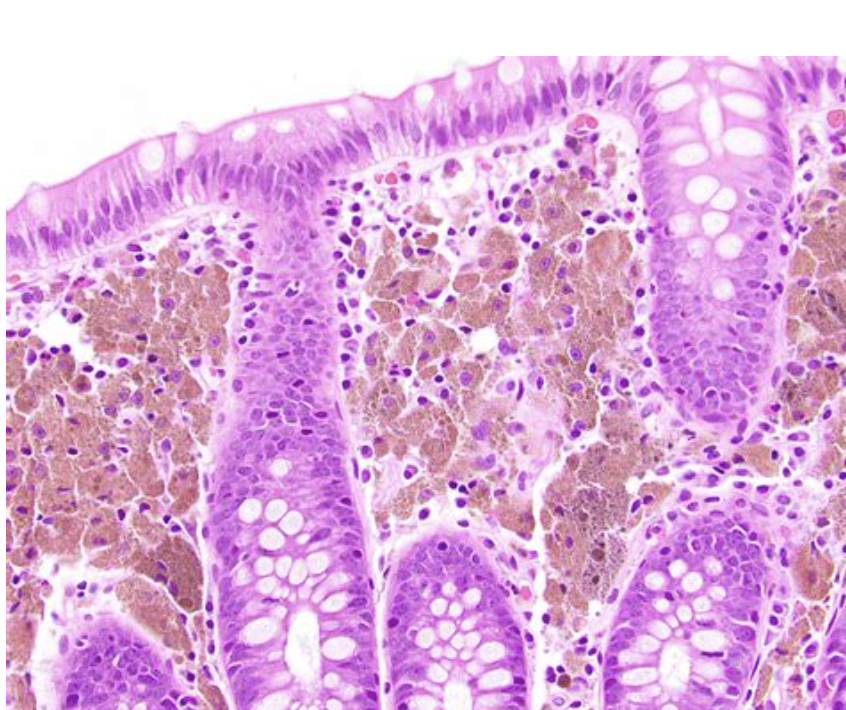 <p>1) Diagnostic</p><p>2) colo spéciale </p>