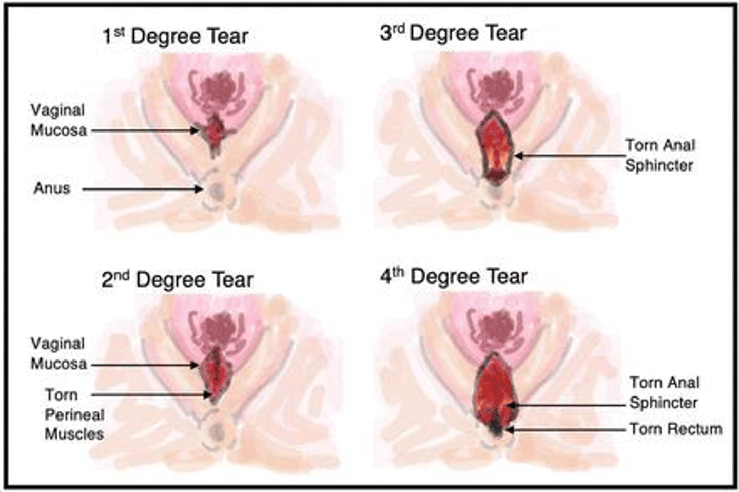 <p>1st degree: skin and mucous membranes; 2nd degree: plus fascia; 3rd degree: plus rectal sphincter; 4th degree: plus rectal lumen.</p>
