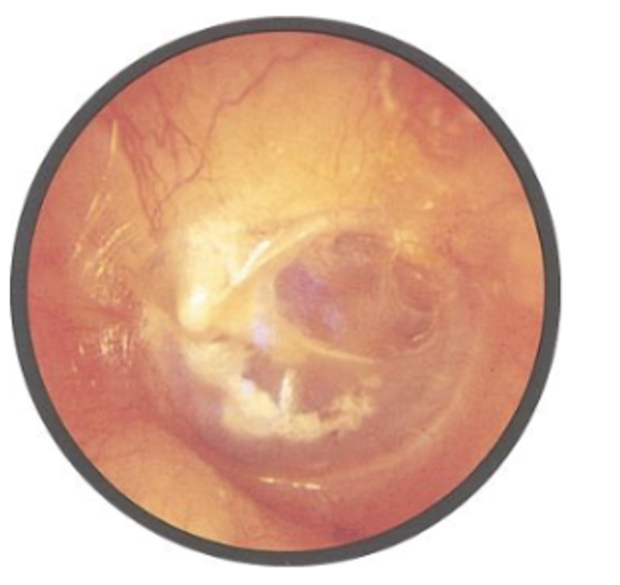<p>scarring process in the middle ear due to otitis media, which can result in conductive hearing loss. It is characterized by deposition of hyaline, calcium, and phosphate crystals in the tympanic membrane and middle ear</p><p>generally not clinically significant</p>