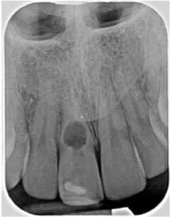 <p>what this radiograph? <span><strong>Resorption often associated with an inflammatory response in the pulp or an idiopathic reason</strong></span></p>