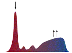 <p>What type of gammopathy is being shown in this plasma protein electrophoresis graph?</p>