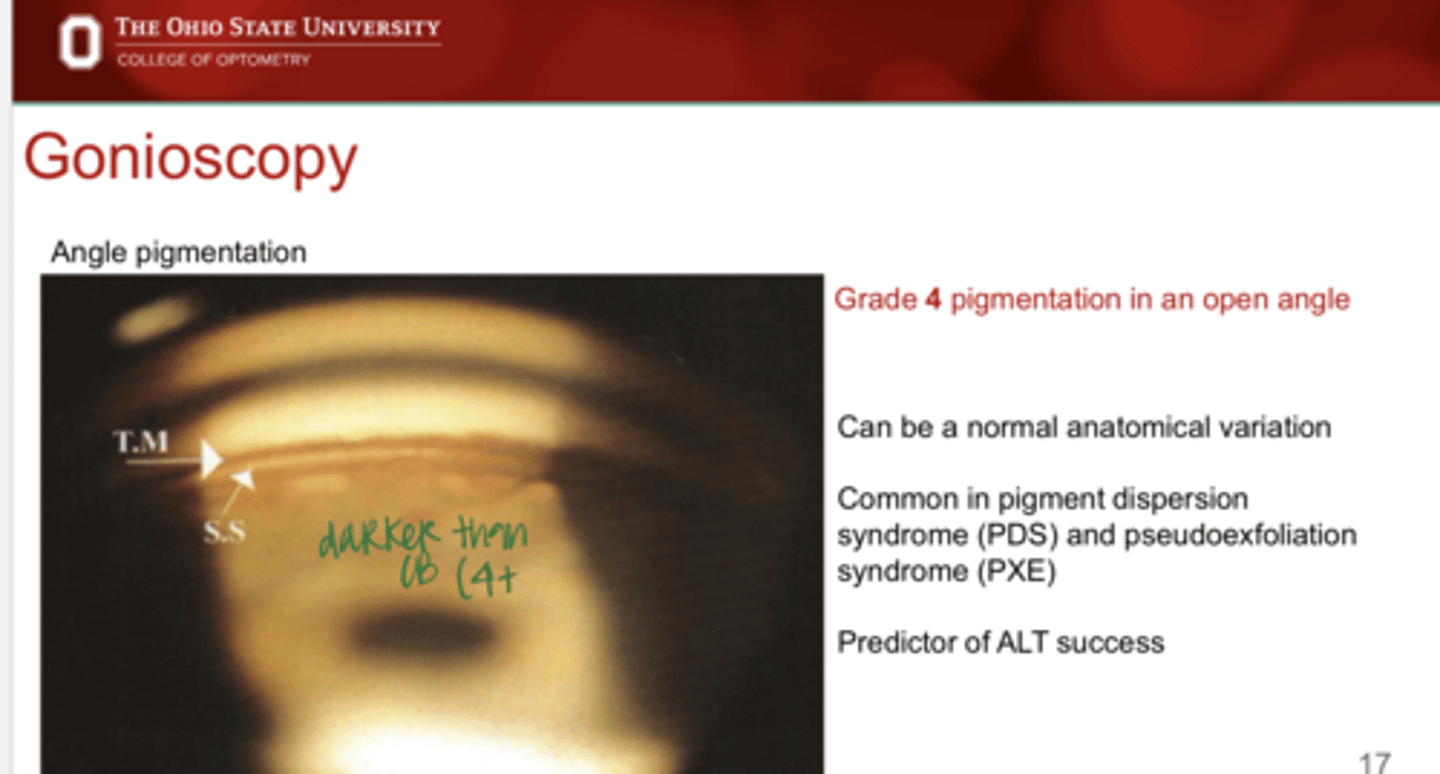 <p>Levels of pigment in the angle is a predictor of ____ success</p>