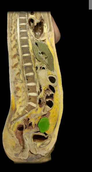 <p><span>Sigmoid colon</span></p>