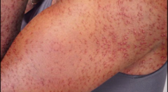 <p>acute inflammation of the sweat ducts caused by blockage of the sweat pores by macerated stratum corneum</p>