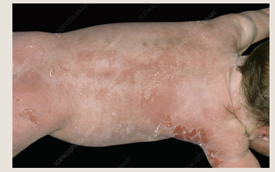 <p>what syndrome is this</p>