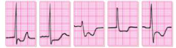 <p>what does this EKG show? </p>