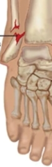 <p>What is the name of this fracture?</p>