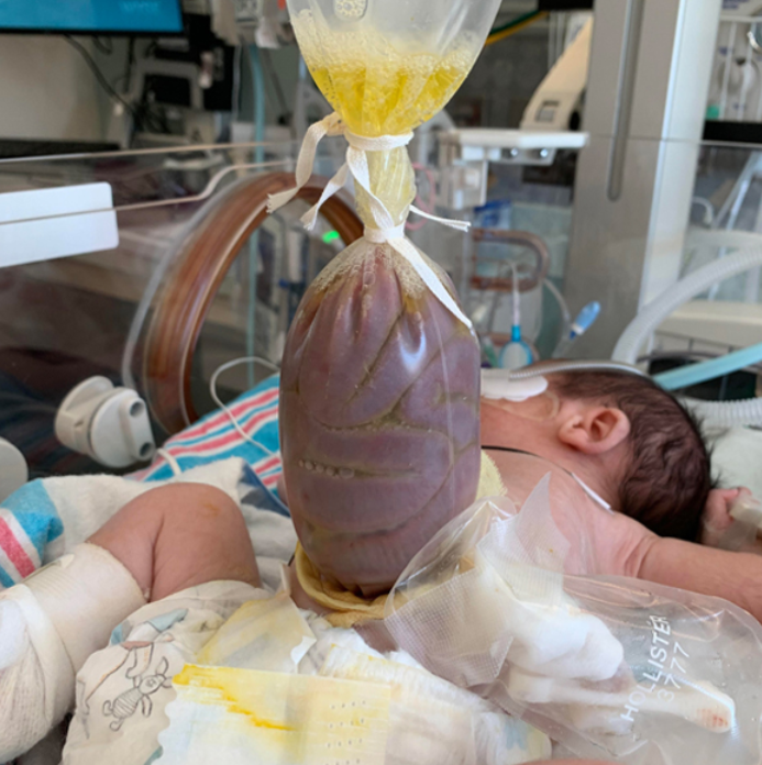 <ol><li><p><span style="color: rgb(231, 117, 199);"><strong>cover </strong></span>in sterile, saline soaked gauze</p></li><li><p><span style="color: rgb(109, 91, 227);"><strong>wrap </strong></span>lower half of body in clear sterile bag</p></li></ol><p></p>