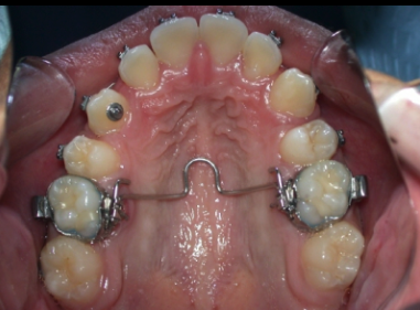 <p>TPA (transpalatal arch) Appliance</p>