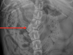 <p>What spinal malformation refers to failure of development of one half of the vertebrae? It can be dorsal (kyphosis), lateral (scoliosis), or ventral (lordosis). It can be incidental or can cause myelopathy due to primary spinal canal stenosis (presents under a year old) or accelerated degeneration of intervertebral discs with herniation and further stenosis (presents after 5 years old). It can be associated with both forms of spinal arachnoid diverticulum at any age. It is stabilized with surgery.</p>