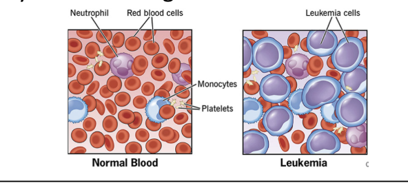 <p><span style="background-color: transparent;">leukemia</span></p>