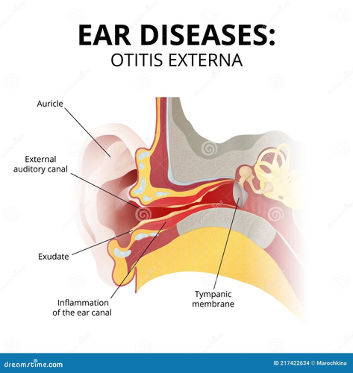 <p>B) external otitis</p><p>EXPLANATION</p><p>Tenderness with pressure on the tragus or traction on the auricle is characteristic in cases of external ear infections.</p>