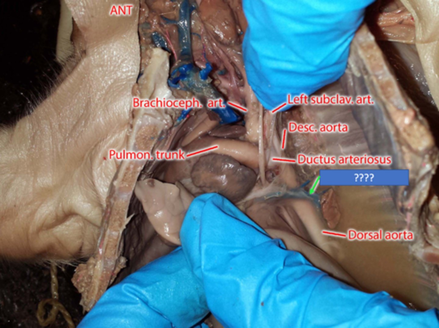 <p>A vein running superiorly in the lower thoracic region, just to the left side of the vertebral column. It generally drains the fifth through eighth intercostal spaces on the left side of the body.</p>