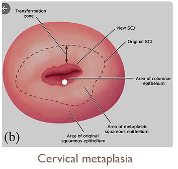 <p>Normal cervical changes at the transformation zone</p><p></p>