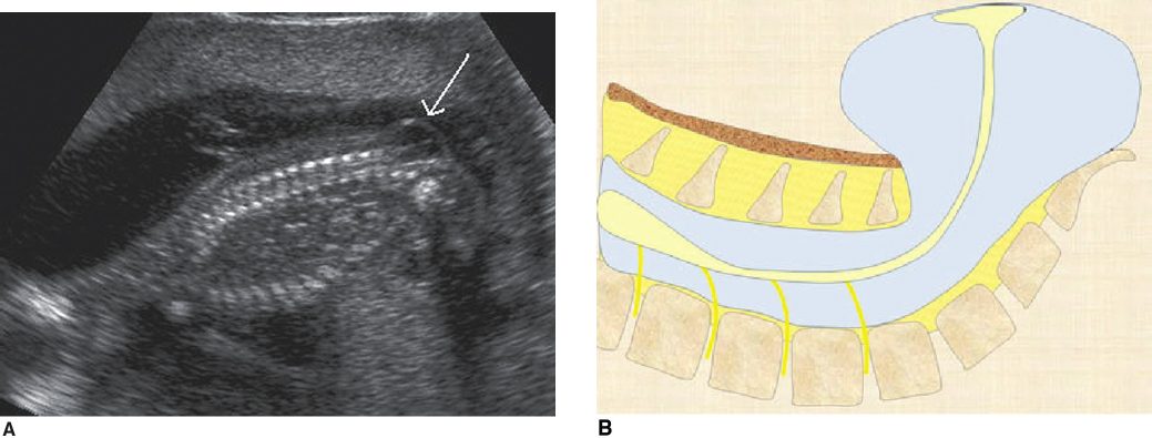<p>distal lumbosacral region</p>