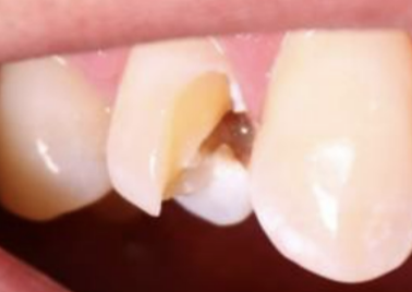 <p>What is a fracture</p>