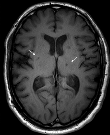 <p>pt has pure contralateral motor deficits, pure c/l sensory deficits, ipsilateral ataxia, dysarthria with hand clumsiness.</p>