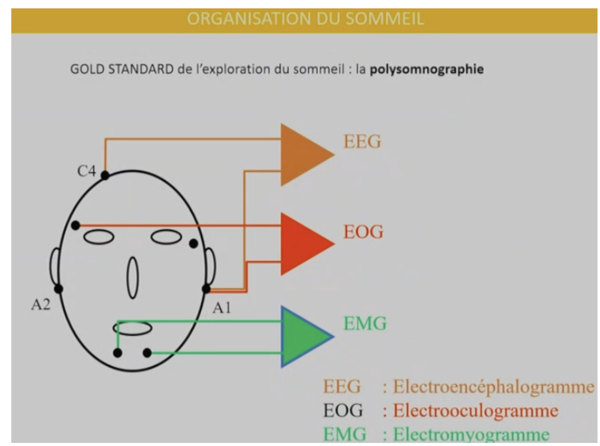 <ul><li><p><span><span>est le </span><strong><span>résultat graphique</span></strong><span> obtenu à partir de la polysomnographie </span></span></p></li><li><p>c’est fait grâce a des capteurs sur le patient</p><ul><li><p>Électrodes sur la tête pour enregistrer l’activité cérébrale pour savoir si il y a eu des troubles respiratoires</p></li><li><p>Capteur sur les yeux pour voir si ils les bougent</p></li><li><p>EMG : enregistrement du tonus musculaire du menton</p></li><li><p>Respiratoire pour mesurer la diminution débit respiratoire ou l’apnée du sommeil</p></li></ul></li></ul><p></p>