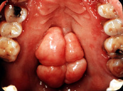 <p>Midline variation on the hard palate</p>